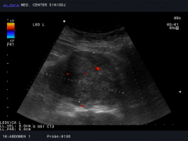 Ultrazvok ledvic - tumor ledvic najverjetneje hipernefrom (svetlocelični karcinom ledvičnih celic)